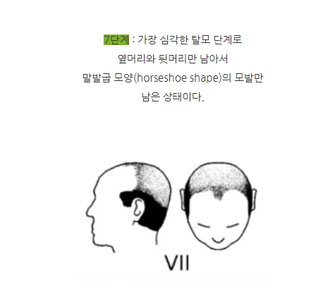 한가발 탈모 상태는 해밀턴 놀우드 7단계로 추정