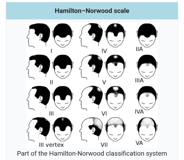 한가발 탈모 상태는 해밀턴 놀우드 7단계로 추정